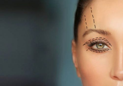 BLEFAROPLASTIA